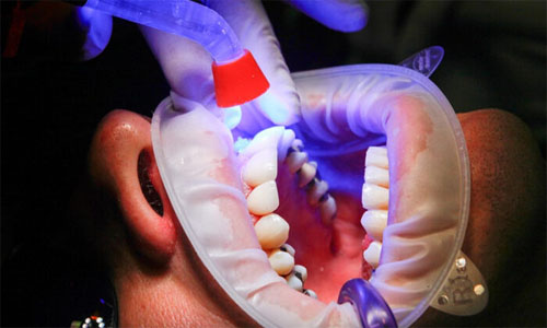 El cánceres orales no se puede detectar en la fase inicial